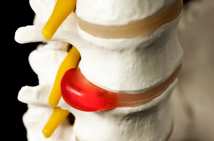 Diagram of a bulging spinal disc pressing on a nerve root, the problem pinched nerve treatment addresses